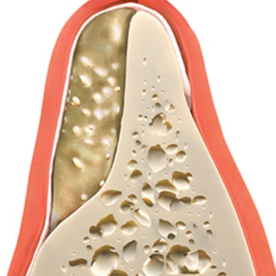 Tooth with bone graft