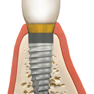 Tooth with bone graft and dental implant