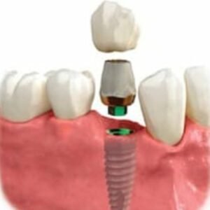 The three parts of a dental implant in Henderson, NV