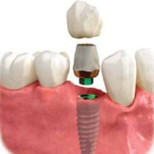 three parts of a dental implant