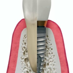 dental implant