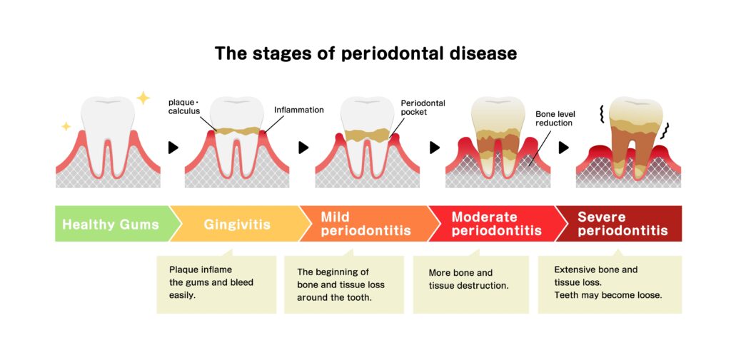 Periodontal Disease has health implications.