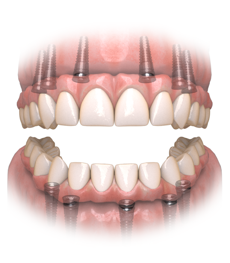 Hybridge Restoration