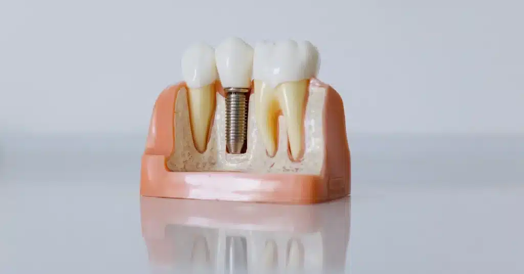Close-up model of a dental implant embedded in gum and bone structure, illustrating placement between two natural teeth, related to bone grafting procedures.