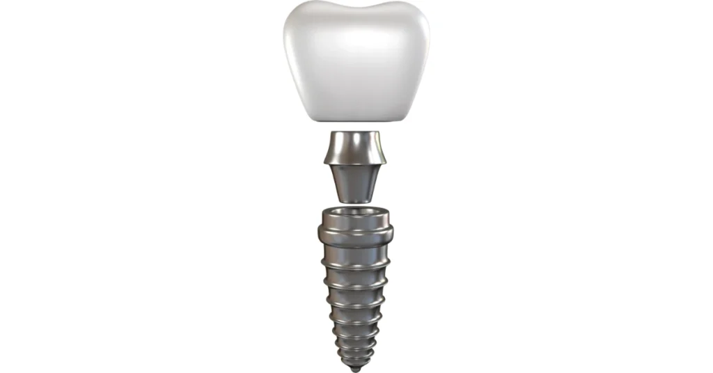 A 3D-rendered image of a dental implant showing the crown, abutment, and titanium screw.