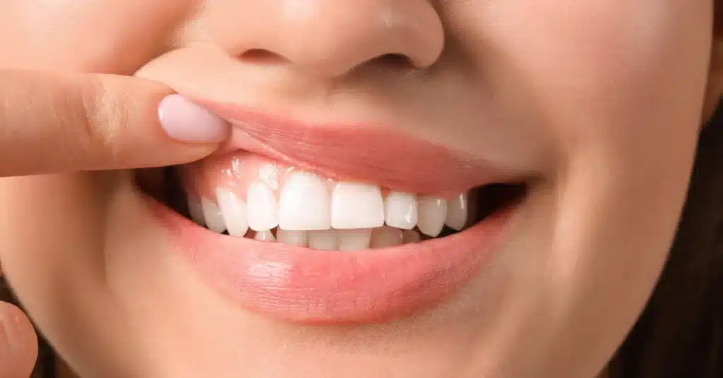 Close-up of healthy pink gums and white teeth after successful gum graft surgery