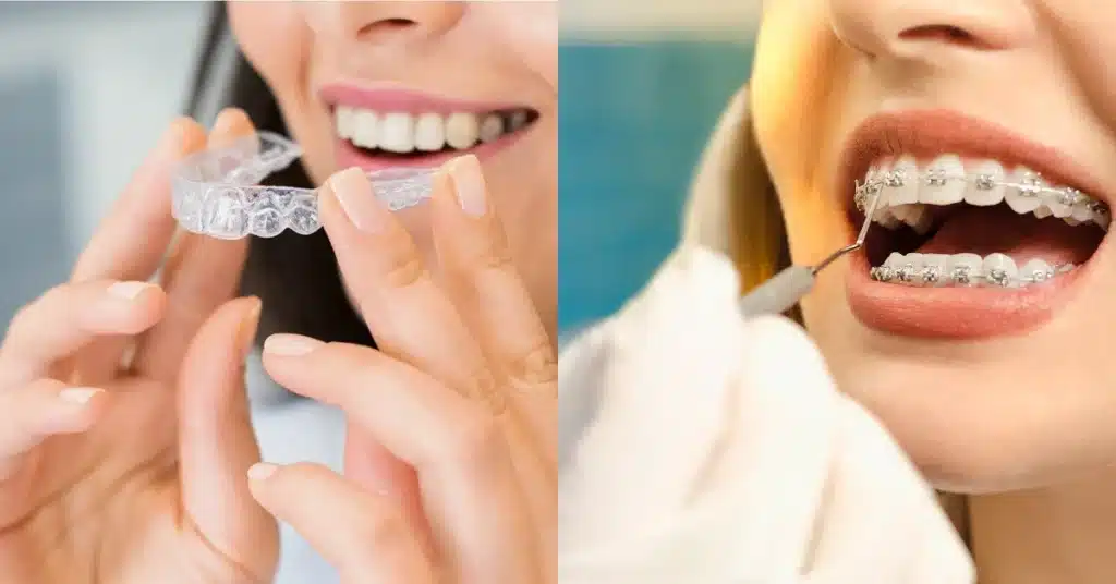 Side-by-side image showing a person holding Invisalign clear aligners on the left and another person receiving dental treatment with traditional metal braces on the right, symbolizing orthodontic treatment options.