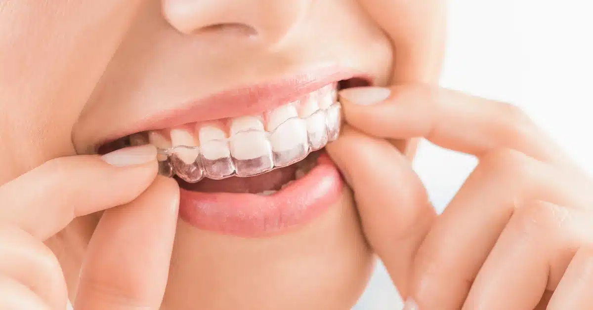 Close-up of a person’s mouth as they put on Invisalign clear aligners, showing the nearly invisible orthodontic trays used for teeth straightening.