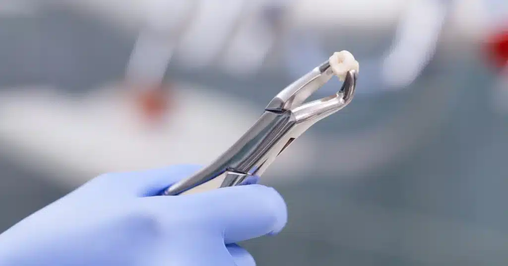 Close-up of extracted tooth held by dental forceps after a professional tooth removal procedure