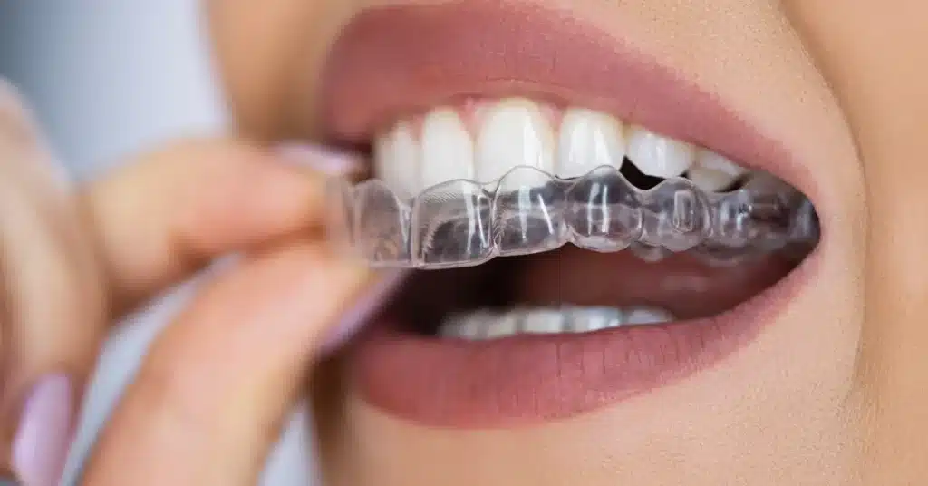 Close-up of a woman inserting a clear mouth guard over her upper teeth, lips slightly parted and fingers guiding the transparent tray.