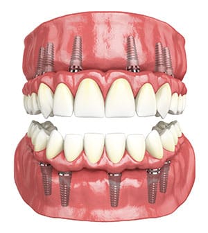 Dental Implants in Henderson, NV