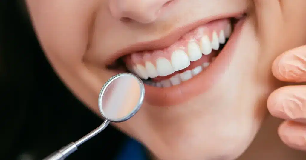 A dentist using a dental mirror to examine a patient’s teeth and smile before a dental bonding procedure to fix minor chips or gaps.