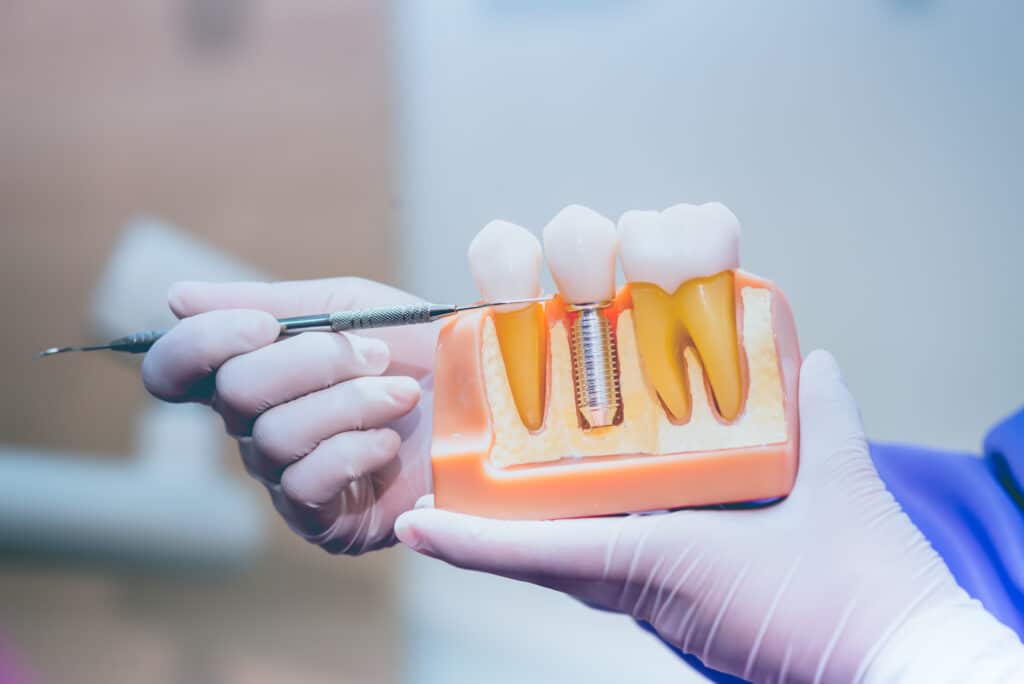 dental implants henderson