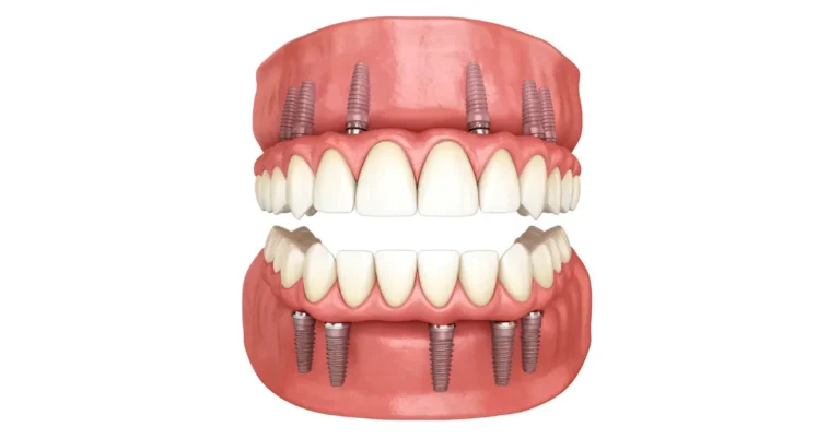 3D illustration showing upper and lower jaw full arch dental implants supporting a complete set of replacement teeth.