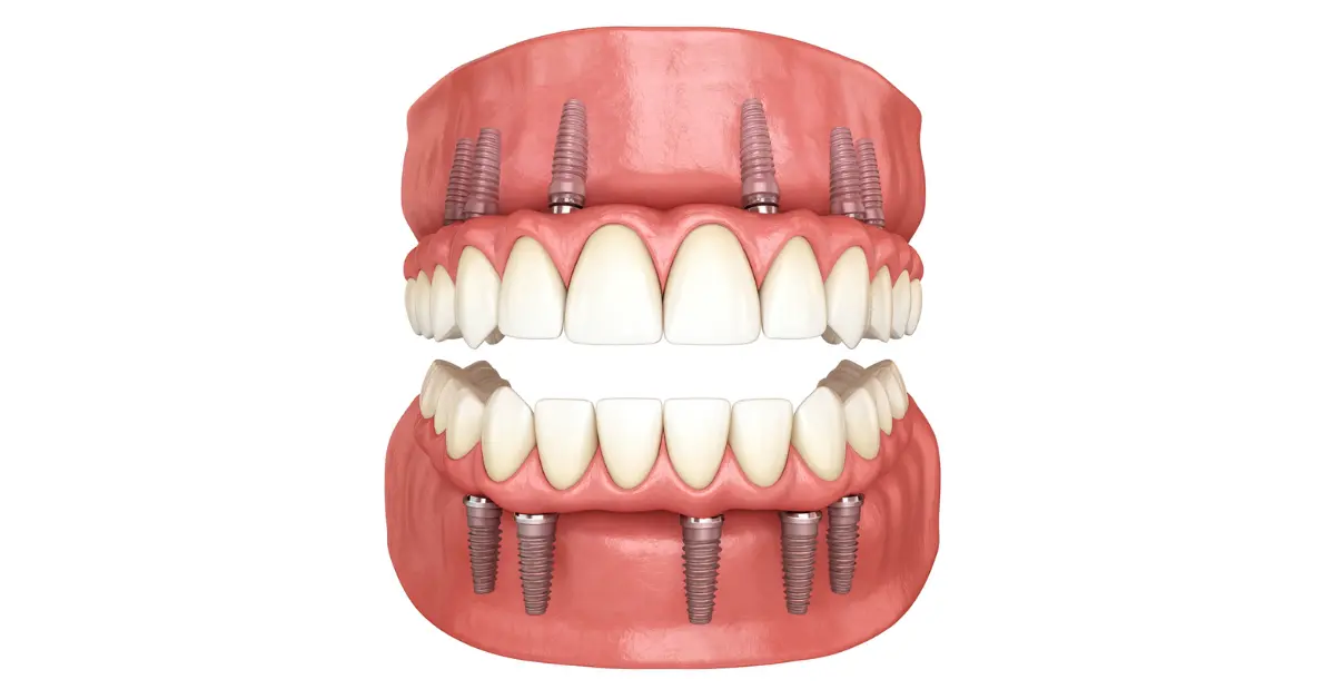 3D illustration showing upper and lower jaw full arch dental implants supporting a complete set of replacement teeth.