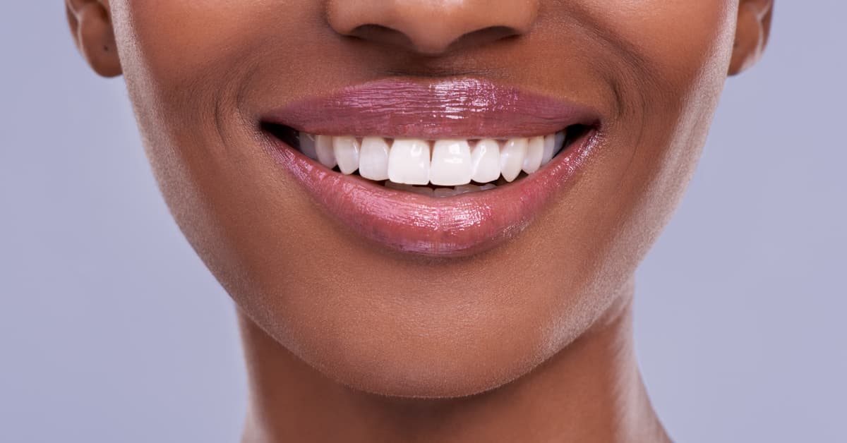 How much are veneers in 2025