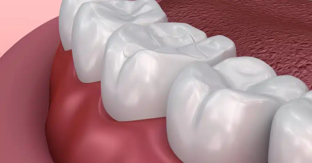 Close-up 3D rendering of molar teeth with protective dental sealants applied to the chewing surfaces to prevent cavities