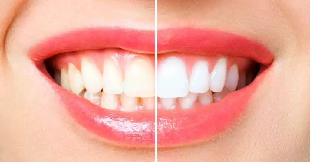 Close-up of a smile showing a split image of teeth before and after whitening treatment, highlighting improved tooth brightness