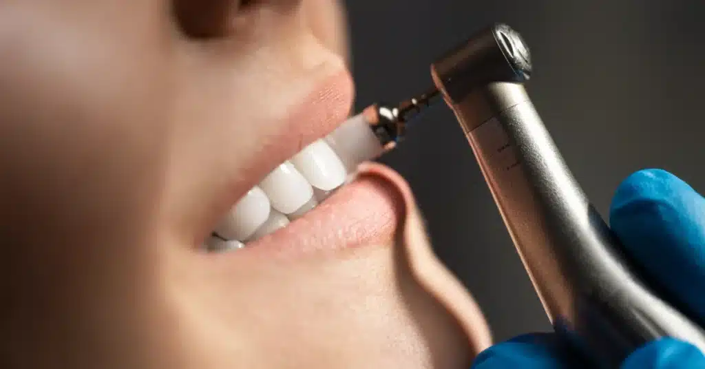 Dentist performing professional teeth cleaning using a dental handpiece on a patient's bright white teeth