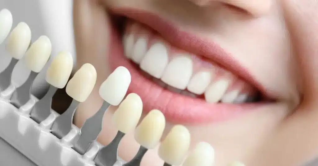 Close-up of a smiling woman comparing her teeth to a dental shade guide, showing color variations for whitening treatment