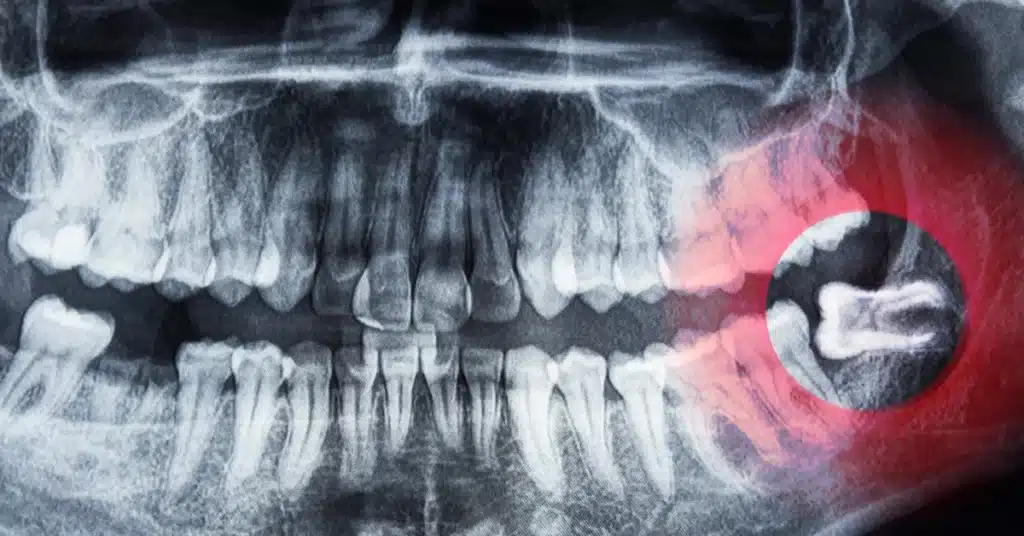 Dental panoramic X-ray showing an impacted wisdom tooth on the lower right side, highlighted in red, indicating need for removal