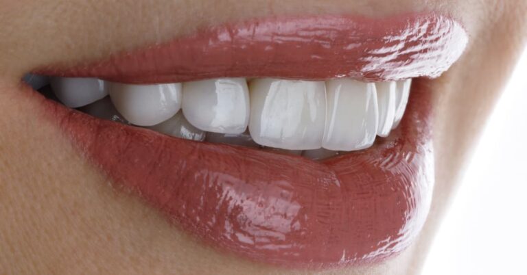 Ceramic veneers