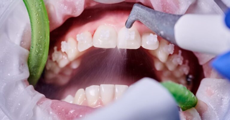 Deep Cleaning Teeth: What Every Patient Needs to Know Before Their First Scaling and Root Planing