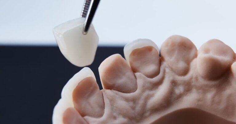 When to replace dental crowns