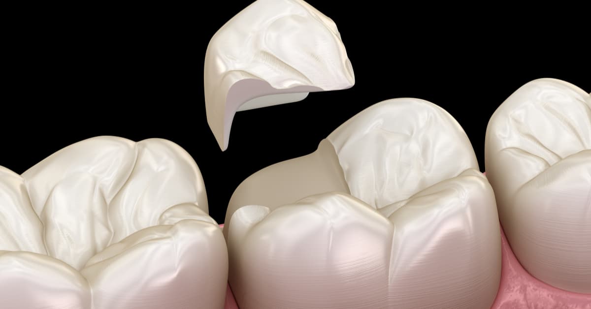 Dental onlay vs crowns