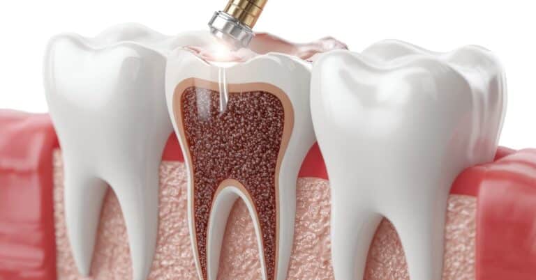 Scaling and Root Planing in Las Vegas: What to Expect from a Deep Cleaning