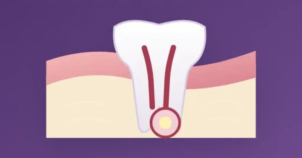 Illustration of an abscessed tooth showing inflammation inside the tooth and an infection pocket near the root tip
