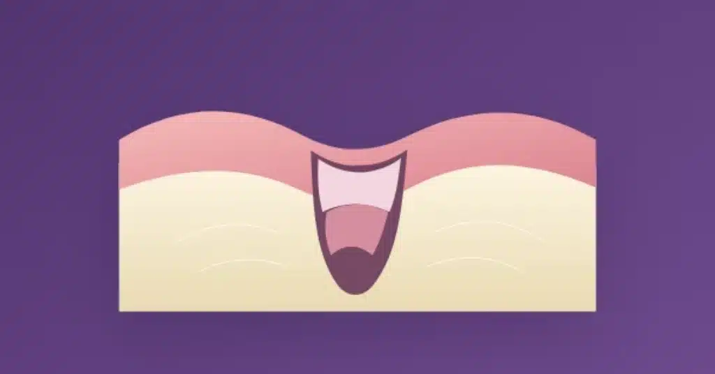 Illustration of granulation tissue healing in a wisdom tooth extraction socket, showing the gum, repair tissue, and deeper bone