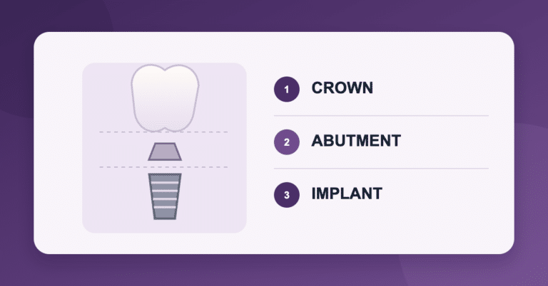 Single tooth implant cost components: crown, abutment, and implant