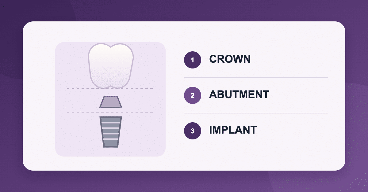 Single tooth implant cost components: crown, abutment, and implant