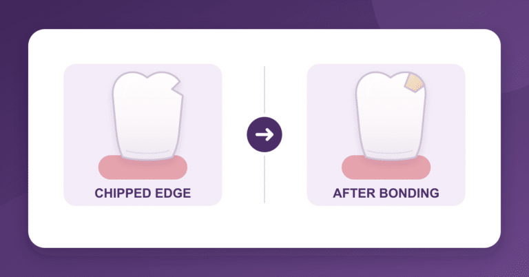 Chipped front tooth before and after composite bonding, illustration