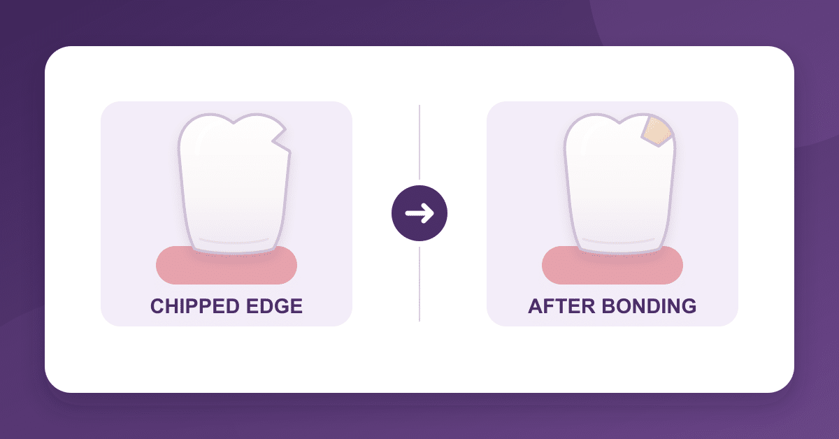 Chipped front tooth before and after composite bonding, illustration