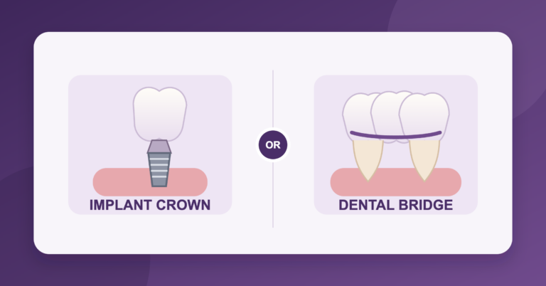 Single tooth implant vs dental bridge comparison