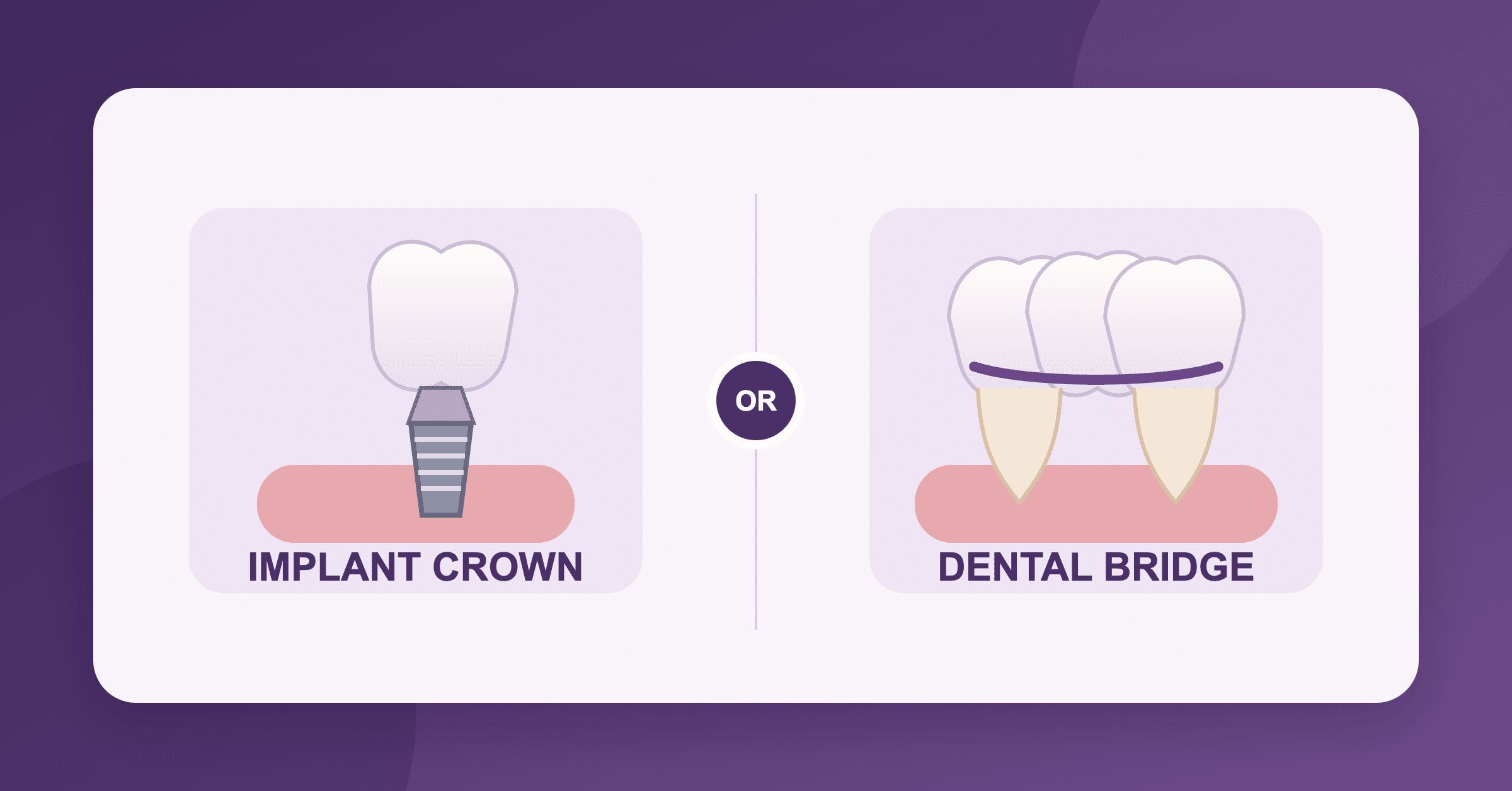 Single tooth implant vs dental bridge comparison