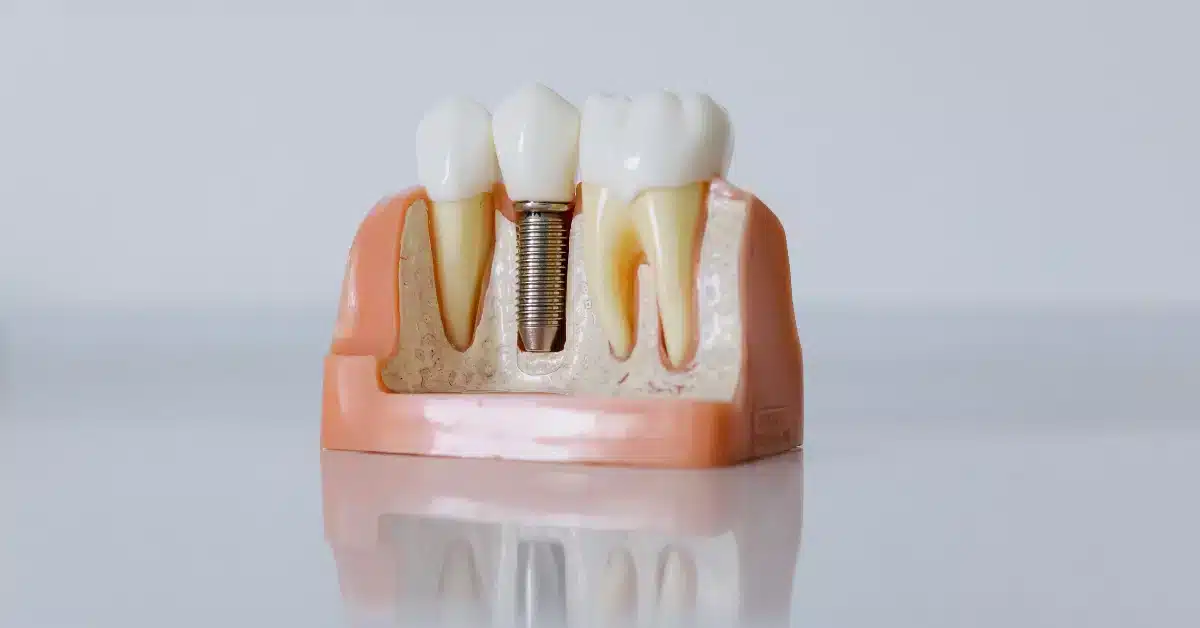 How long do dental implants last: implant post in jawbone model with crown on top