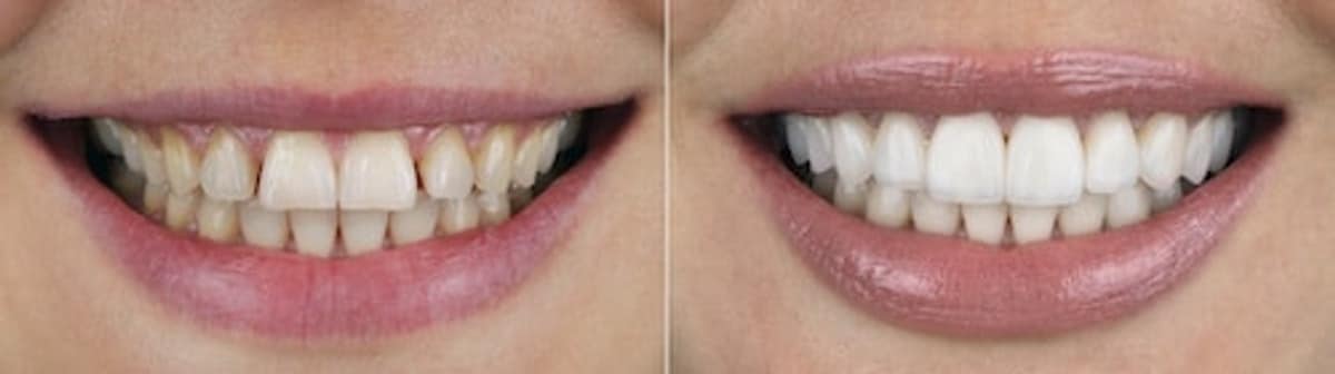 Upper front teeth before and after veneers. Left: yellowed teeth with edges of different lengths and a gap between the two central teeth. Right: the same teeth in one lighter shade with level edges and no gap.
