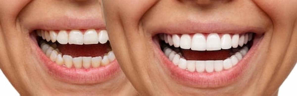 Open smile before and after veneers. Left: straight upper teeth with slight yellowing and uneven widths. Right: the same teeth lighter and more even in size, in the same position.